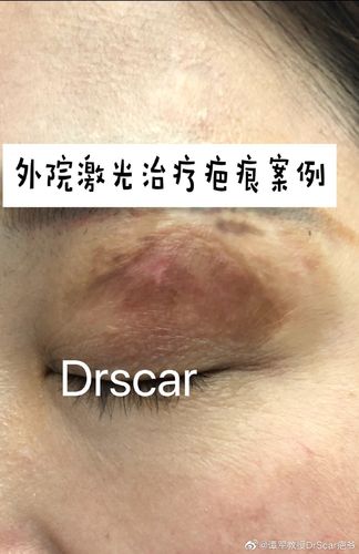 剂量激光皮肤小心(激光皮肤剂量色素疤痕)