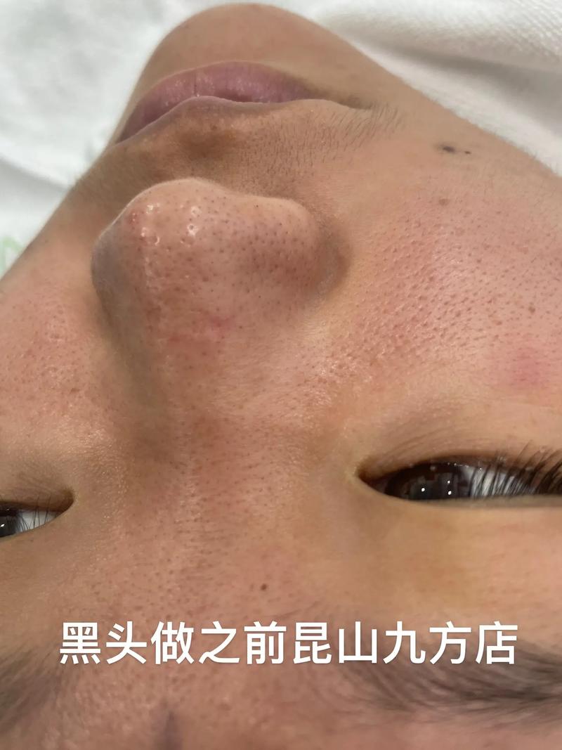 粗大黑头毛孔对了红血丝(清洁粗大氨基酸黑头毛孔)