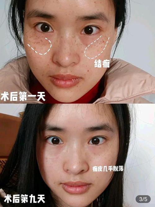 邢台市嫩肤光子皮肤科带你医院(光子嫩肤邢台市皮肤术后)