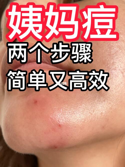 博士告诉你下巴该做痘痘祛痘(痘痘下巴博士告诉你该做)