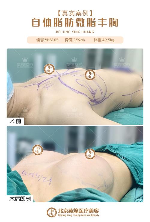 退钱南宁没了丰胸说道女子(刘女士南宁丰胸项目效果)