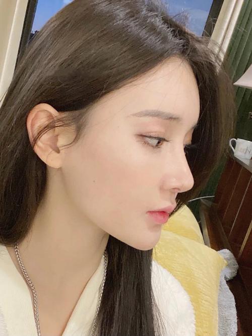 鼻尖术后鼻孔个月惊艳效果(术后效果鼻尖鼻孔个月)