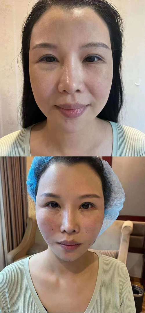 拉皮是怎么好又效果自然(拉皮是怎么效果自然好又)