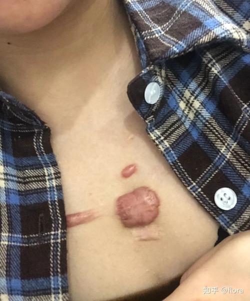 的人瘢痕能做能不体质美容手术(瘢痕体质的人美容手术能做)