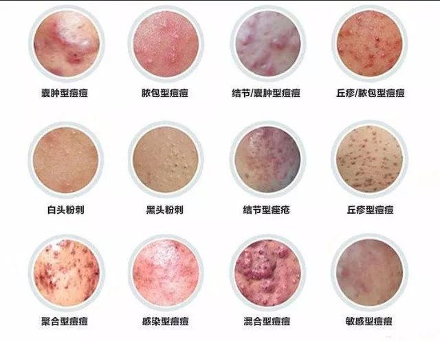 你怎么痘痘这场战争肌肤战场敌人(医生肌肤你怎么痘痘这场战争)