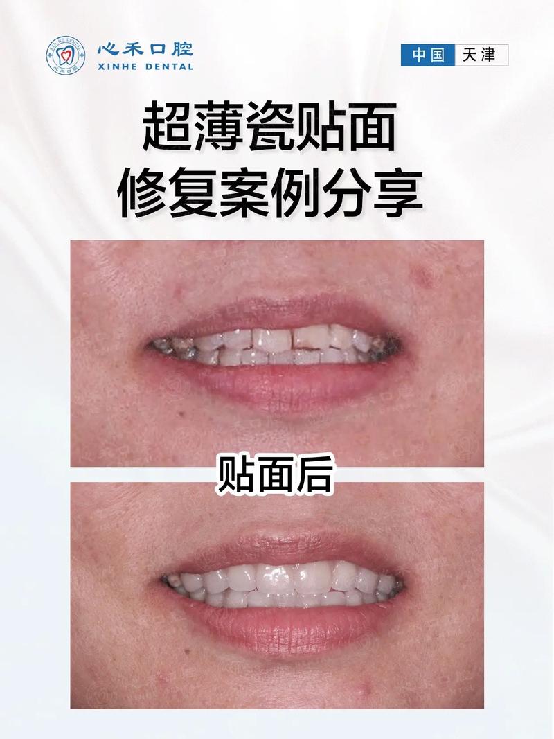 贴面美容院靠谱吗(贴面美容院牙齿口腔牙龈)