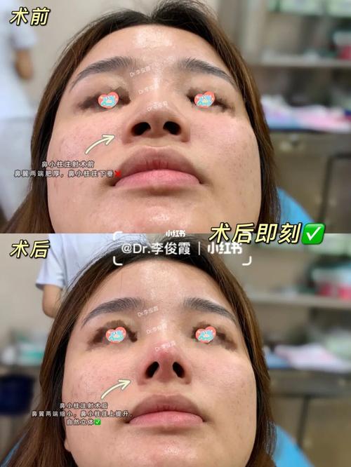 做些什么功课(切口医生隆鼻小柱做些什么)