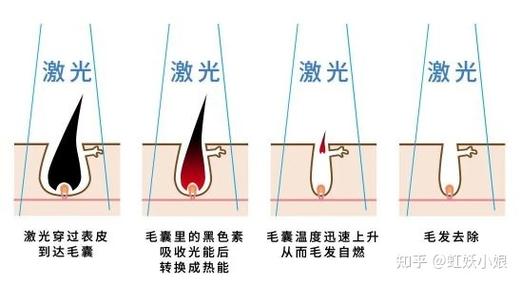 仪器比较好哪种原理(毛囊仪器原理激光比较好)