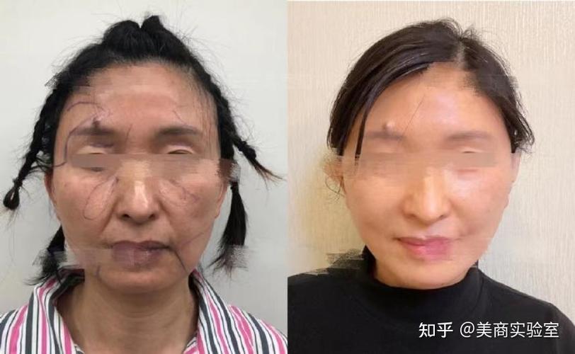 拉皮这几个也做很香害怕医生(拉皮项目眼袋面部医院)