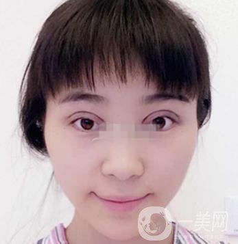 瑞丽双眼皮觉得自己(瑞丽双眼皮觉得自己陈女士麻药)