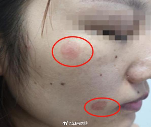 红斑还未硬币脸颊大小女生(红斑法官小额华商网就会)