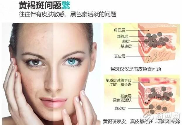 咋办(咋办黄褐斑皮肤头条的说)